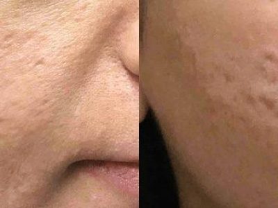 rf-skin-resurfacing-before-after